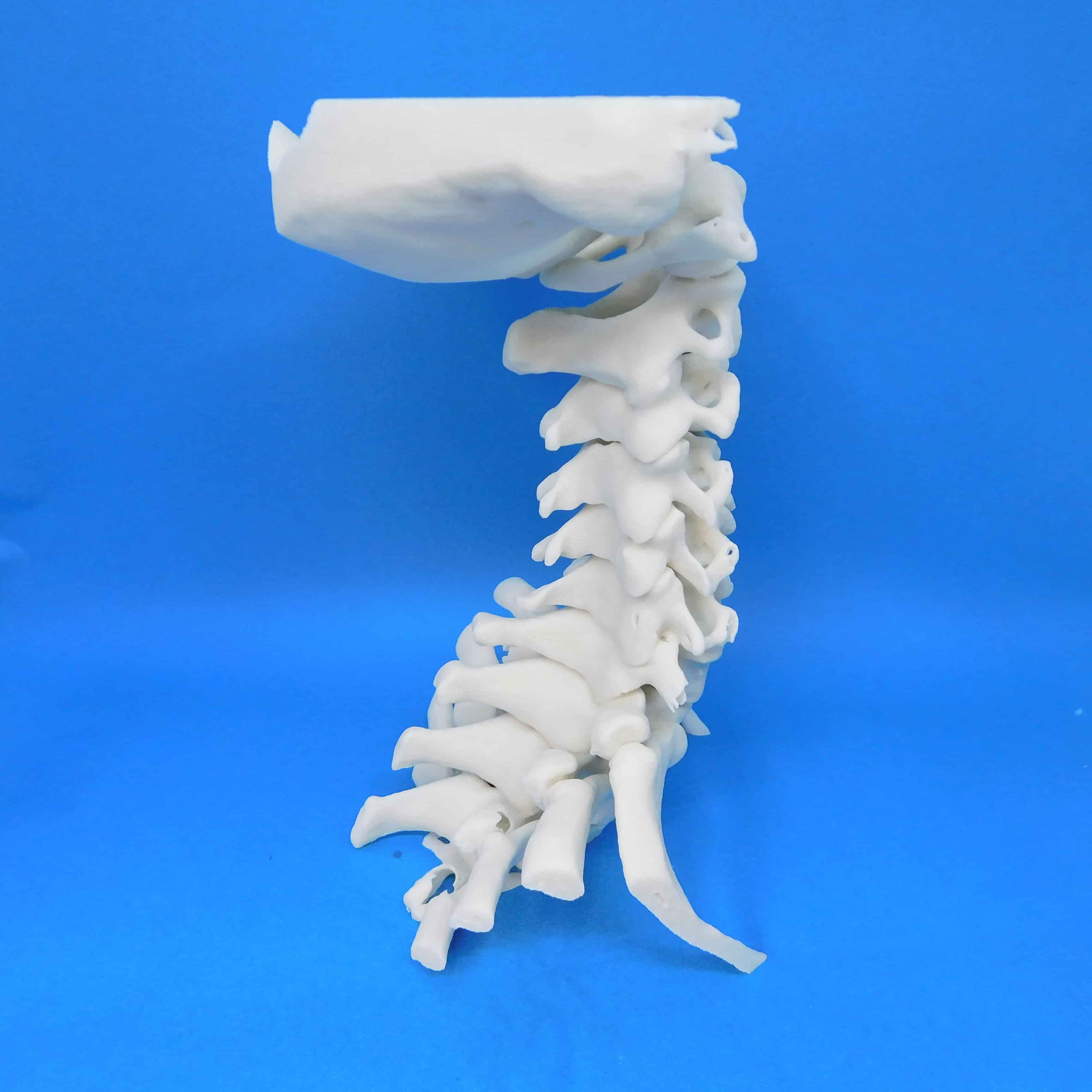 症例頸椎1 F91の医療模型 | 3DモデルのKEZLEX